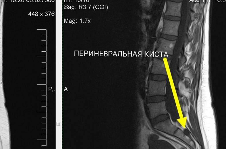 МРТ пояснично-крестцового и крестцово-копчикового отдела позвоночника