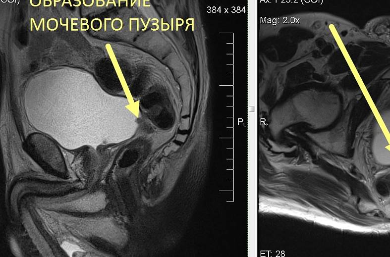 Диффузно-взвешенное магнитно-резонансное изображение (DWI MRI) ( для обеспечивания контрастности картинки)