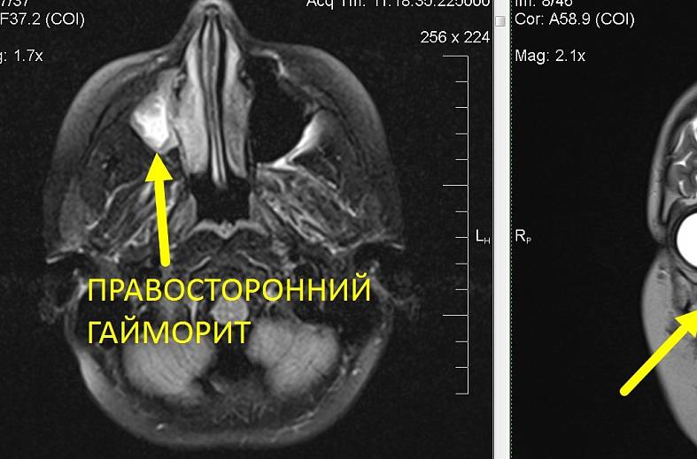 МРТ придаточных пазух носа