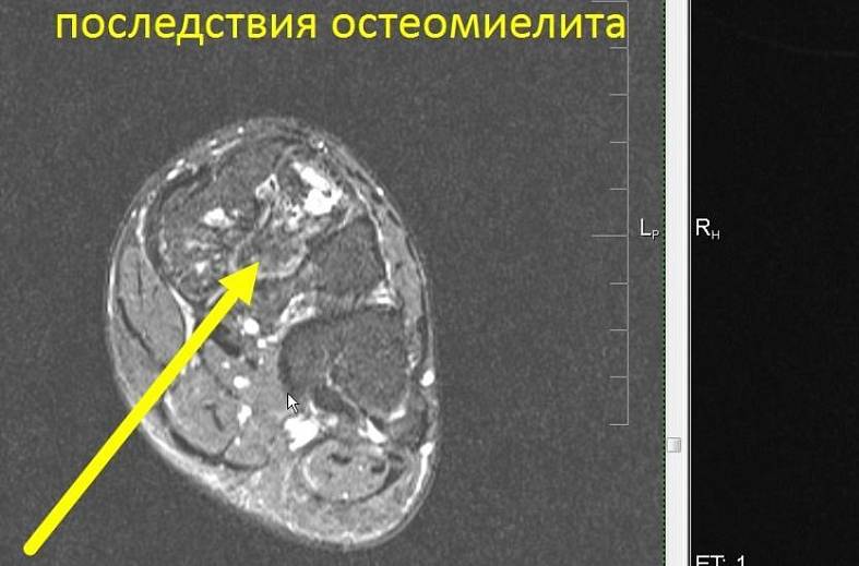 МРТ голеностопного сустава
