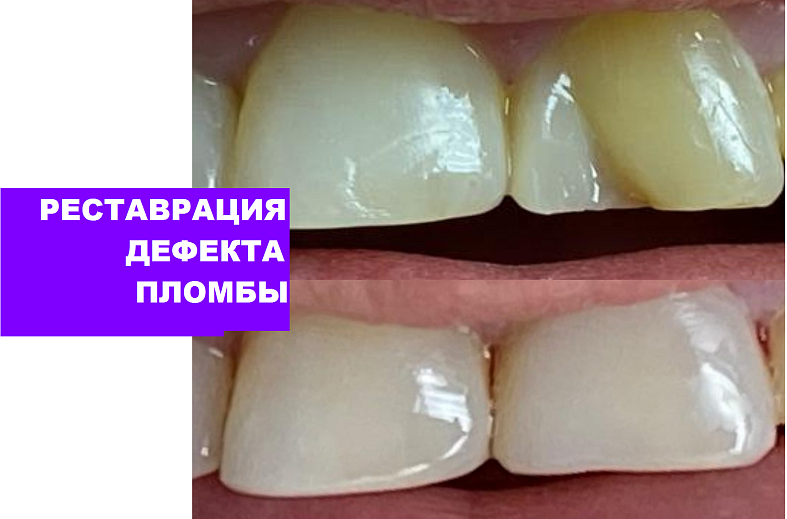 Первичный прием стоматолога с диагностикой интраоральной видеокамерой