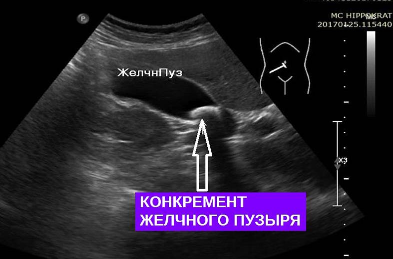 УЗИ печени плюс желчный пузырь