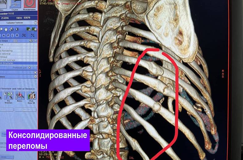 КТ органов грудной клетки 