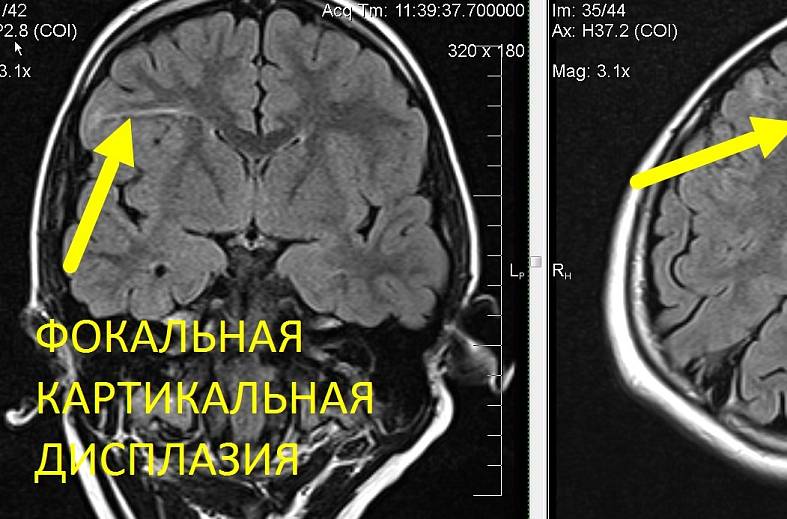 Высокопольная МРТ головного мозга по программе эпилептологического сканирования