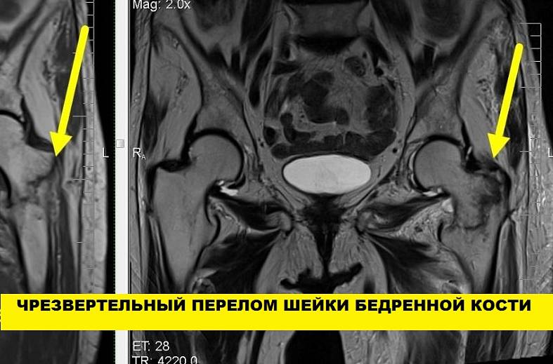 МРТ тазобедренных суставов (пара суставов)