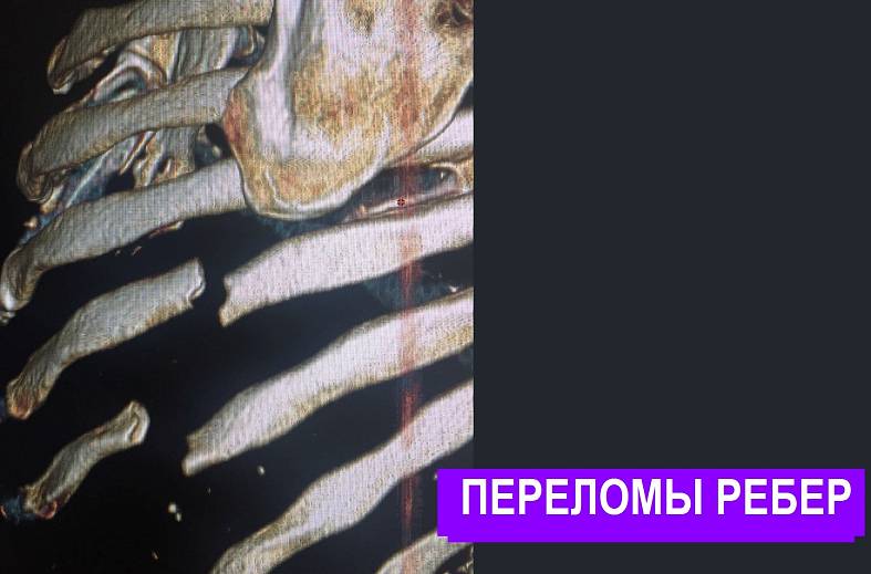 КТ органов грудной клетки 