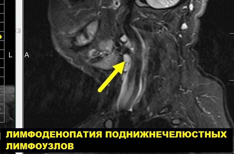 МРТ мягких тканей шеи