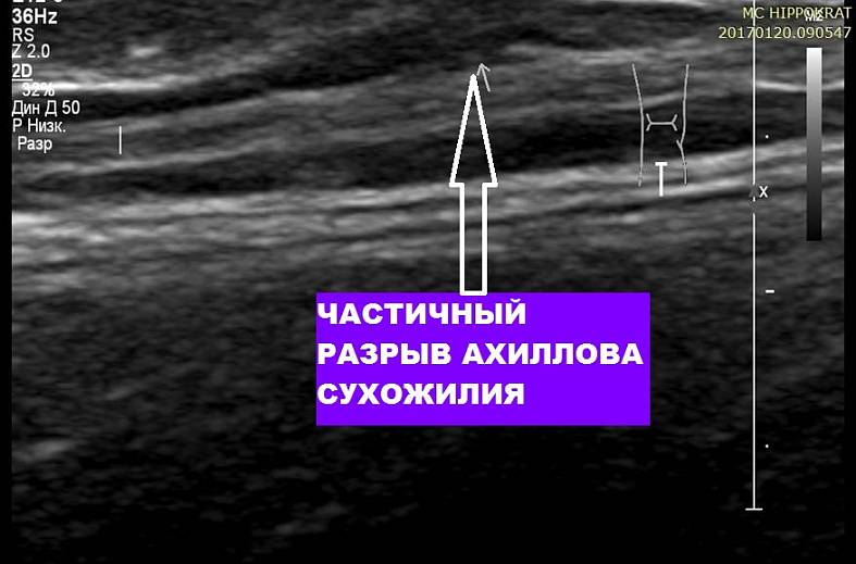 УЗИ голеностопного сустава (1 сустав) на аппарате элитного класса