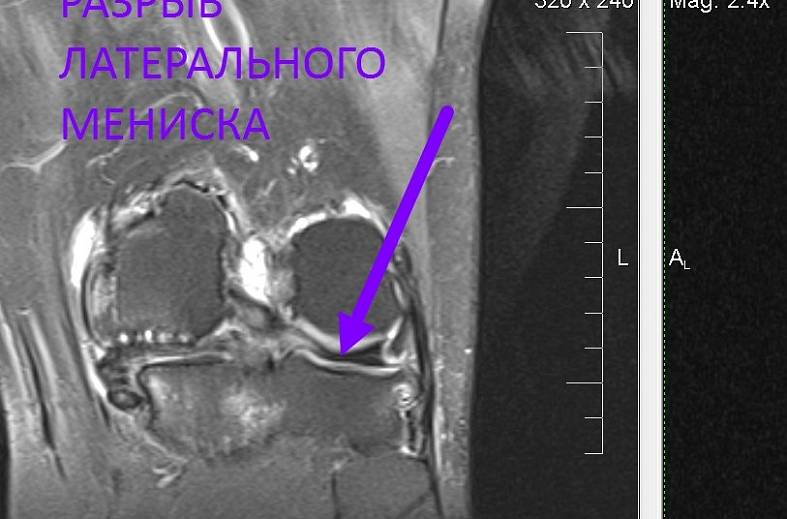 МРТ коленного сустава на 15-канальной катушке
