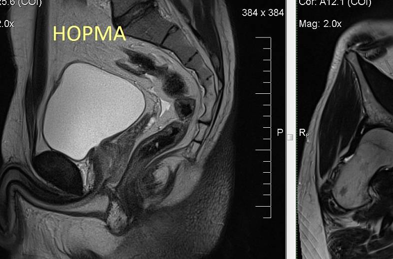 Диффузно-взвешенное магнитно-резонансное изображение (DWI MRI) ( для обеспечивания контрастности картинки)