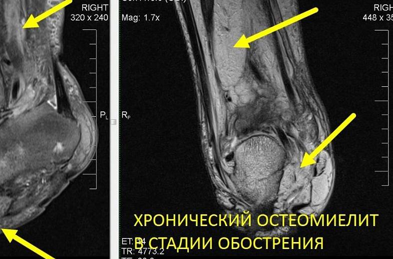 МРТ голеностопного сустава