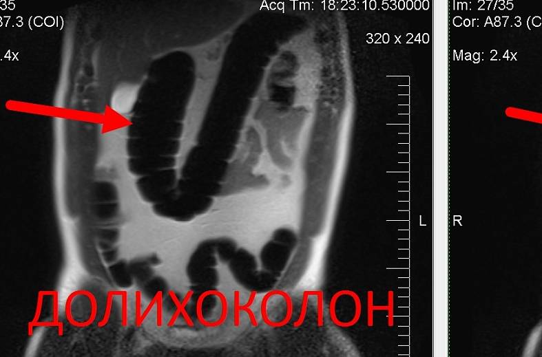 МРТ толстого кишечника (колонография)