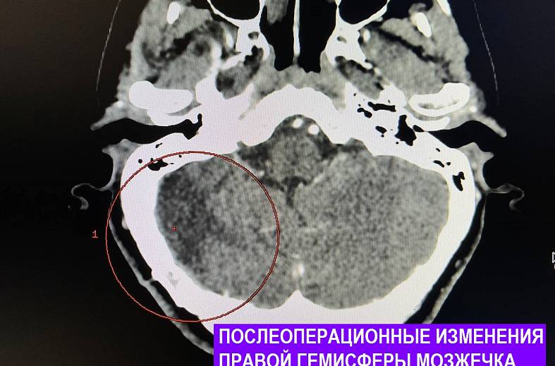 КТ головного мозга