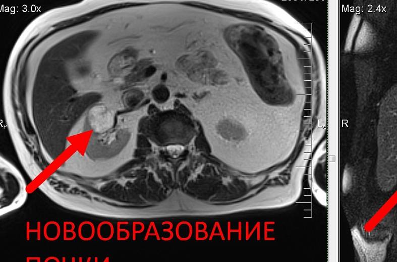 МРТ органов забрюшинного пространства (почки, надпочечники, нижняя полая вена, лимфатические узлы, брюшной отдел аорты)