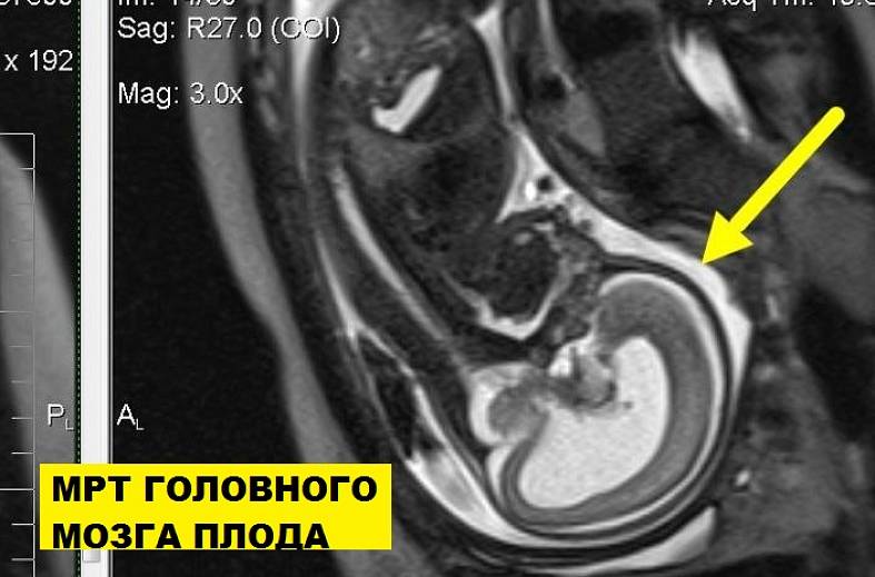 МРТ беременности с 22 недели (пороки развития плода, патология матери, определение пола)