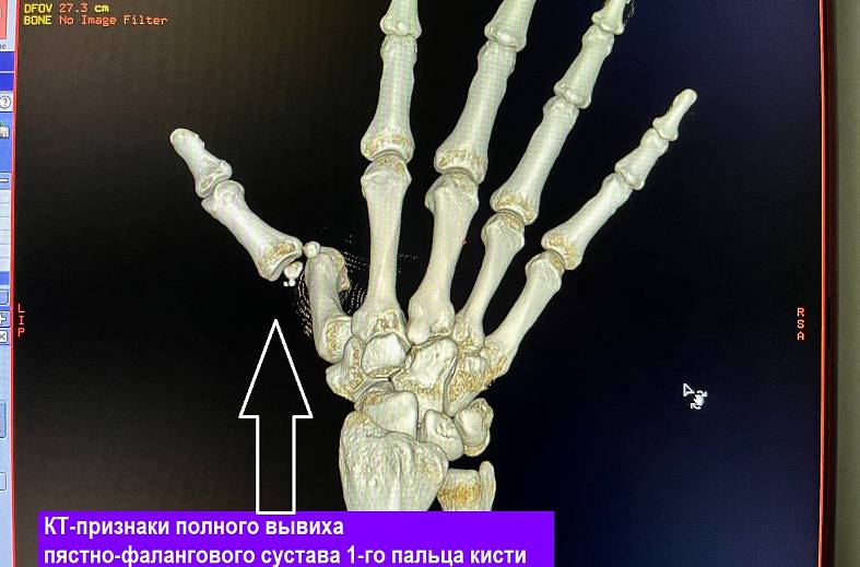 КТ кисти