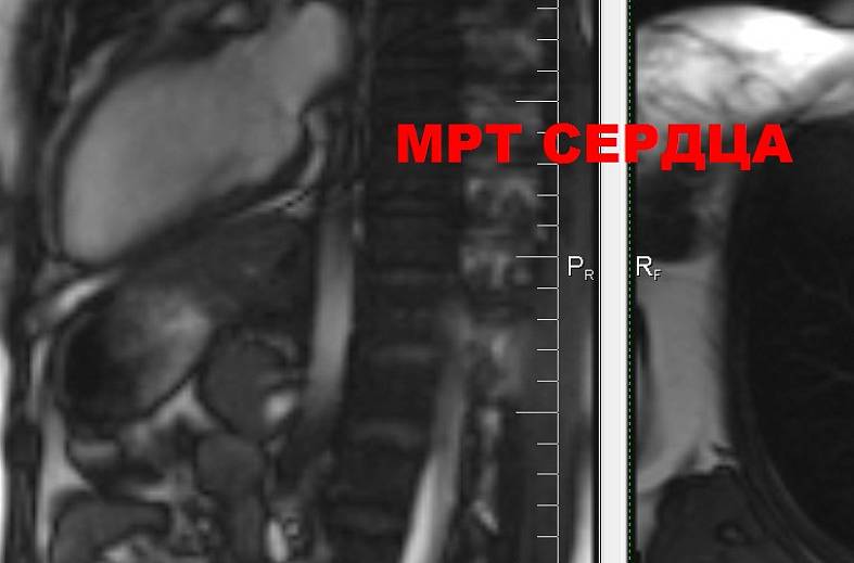 МРТ сердца + контрастирование