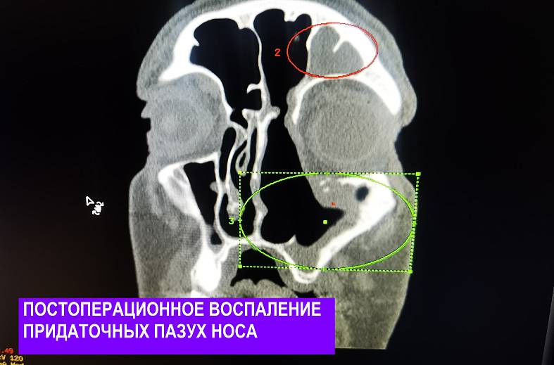 КТ придаточных пазух носа
