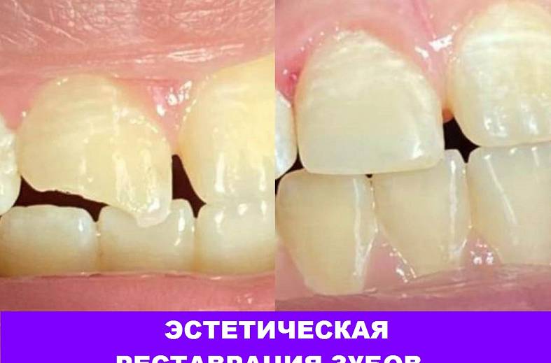 Первичный прием стоматолога с диагностикой интраоральной видеокамерой