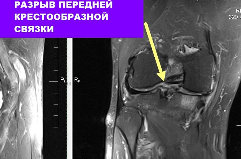 МРТ коленного сустава на 15-канальной катушке