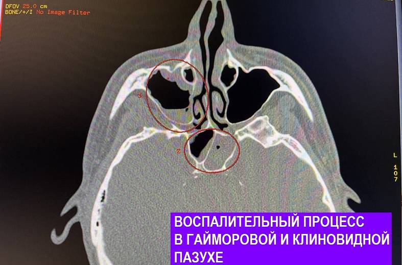 КТ придаточных пазух носа