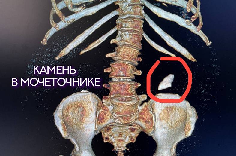 КТ мочевыводящих путей, экскреторная урография (почки, мочеточники, мочевой пузырь, лимфатические узлы)