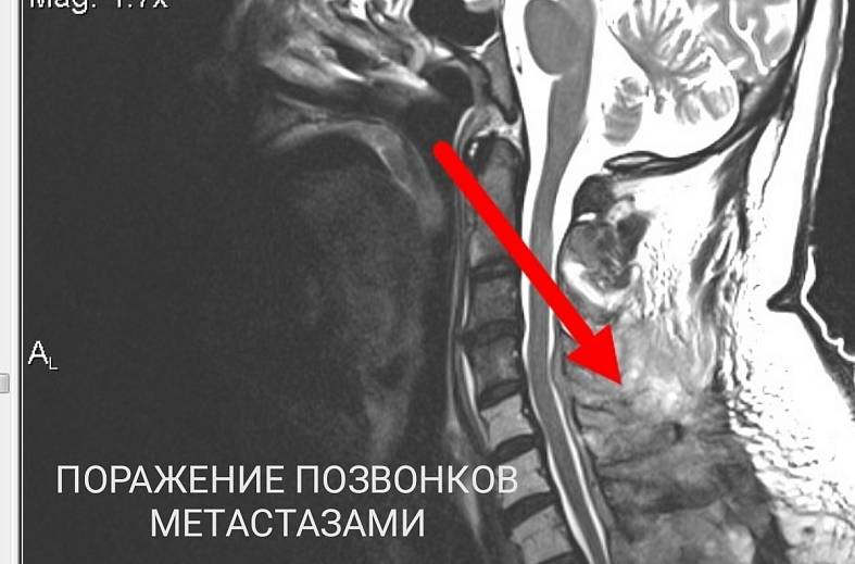 МРТ шейного отдела позвоночника