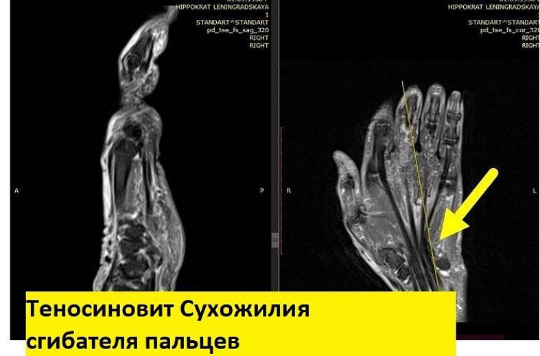 МРТ-исследование кисти