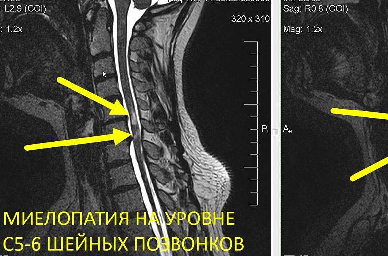 МР-миелография (один отдел позвоночника)