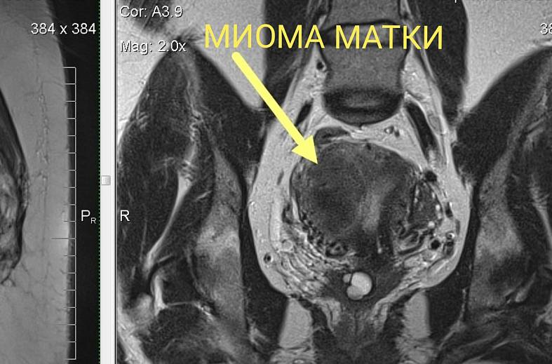 МРТ органов женского малого таза (матка, яичники, мочевой пузырь, влагалище, сосуды малого таза, лимфатические узлы)