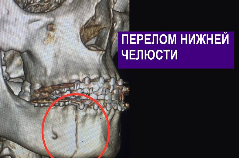 КТ лицевого скелета