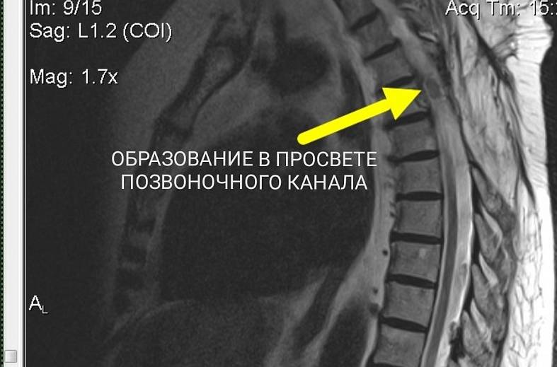 МРТ грудного отдела позвоночника