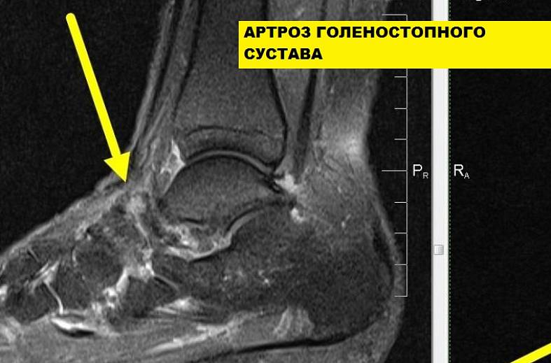 МРТ голеностопного сустава