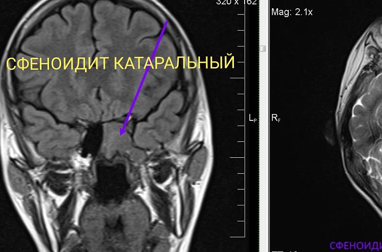 МРТ придаточных пазух носа