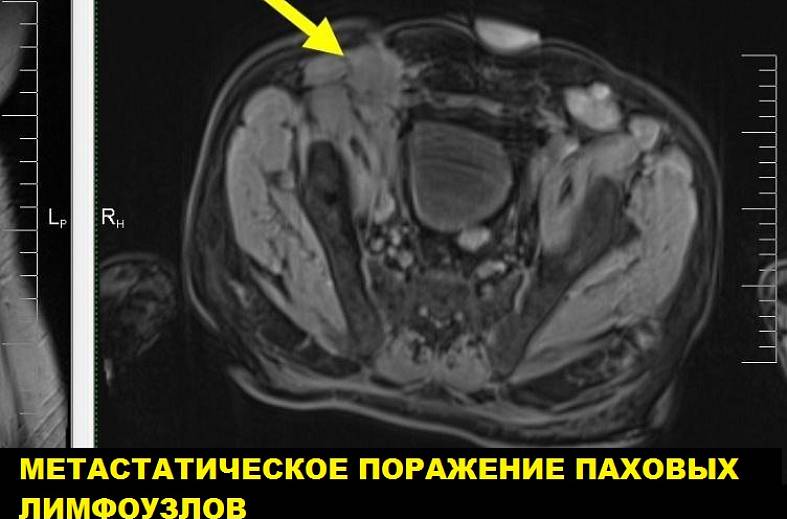 Диффузно-взвешенное магнитно-резонансное изображение (DWI MRI) ( для обеспечивания контрастности картинки)