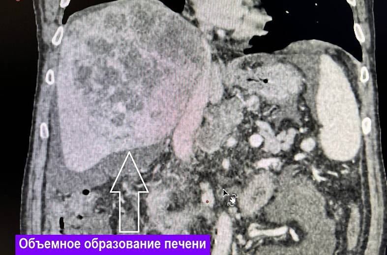 КТ органов брюшной полости