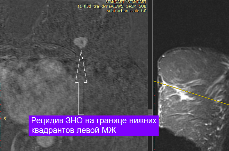 МРТ-исследование молочных желез + контрастирование