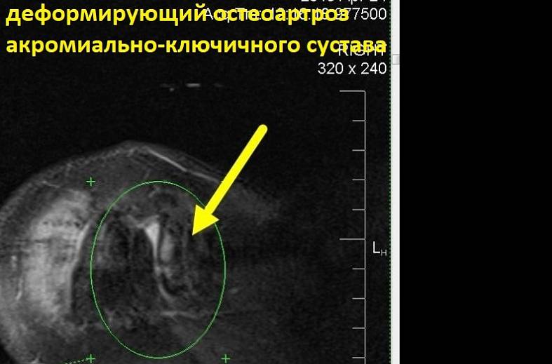 МРТ плечевого сустава