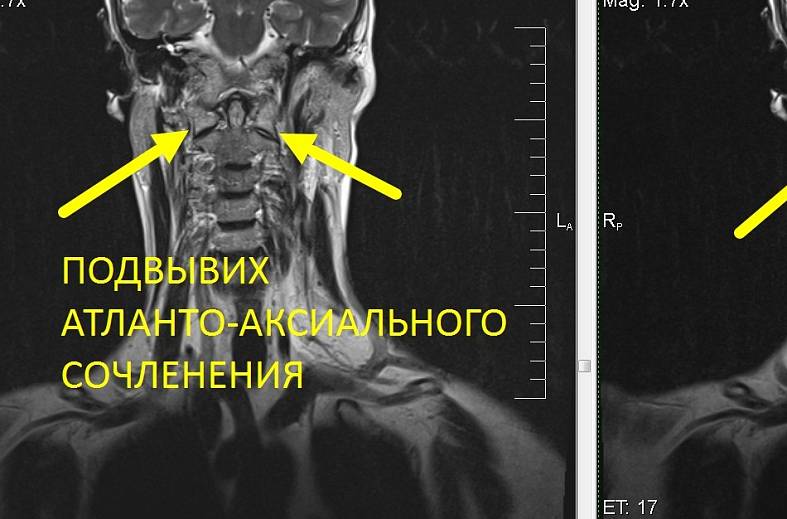 МРТ кранио-вертебрального перехода