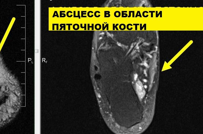 МРТ голеностопного сустава
