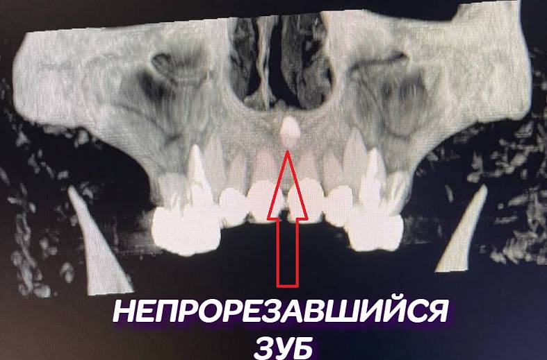 КТ зубов 