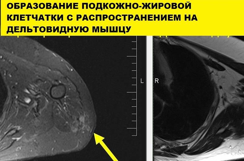 МРТ мягких тканей конечности (одна область)