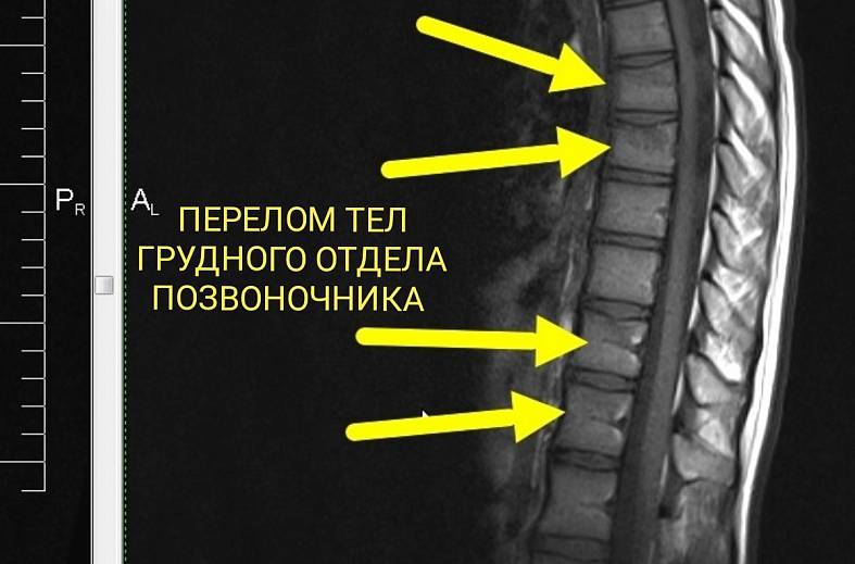 МРТ грудного отдела позвоночника