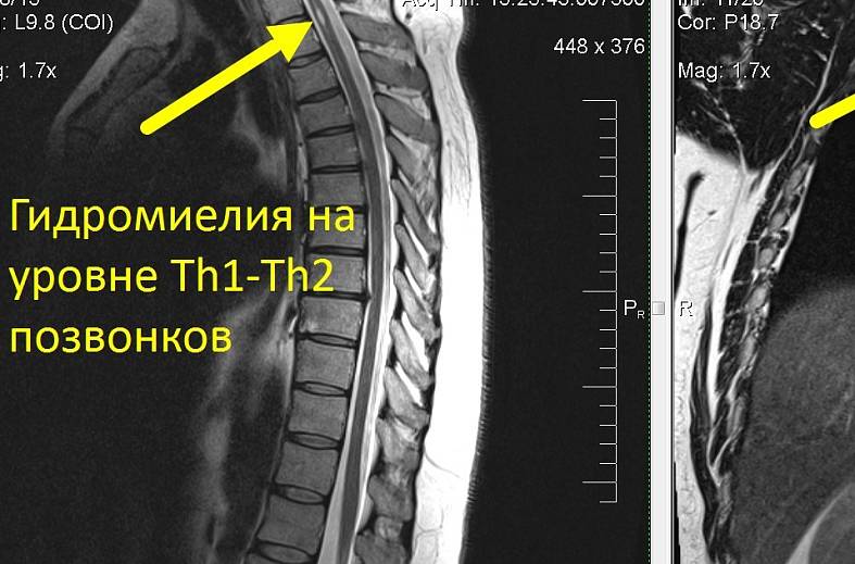 МР-миелография (один отдел позвоночника)