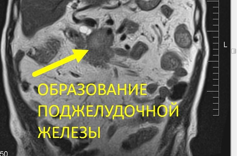 МРТ органов брюшной полости и холангиография (детальный осмотр внутри и вне печеночных желчных протоков)