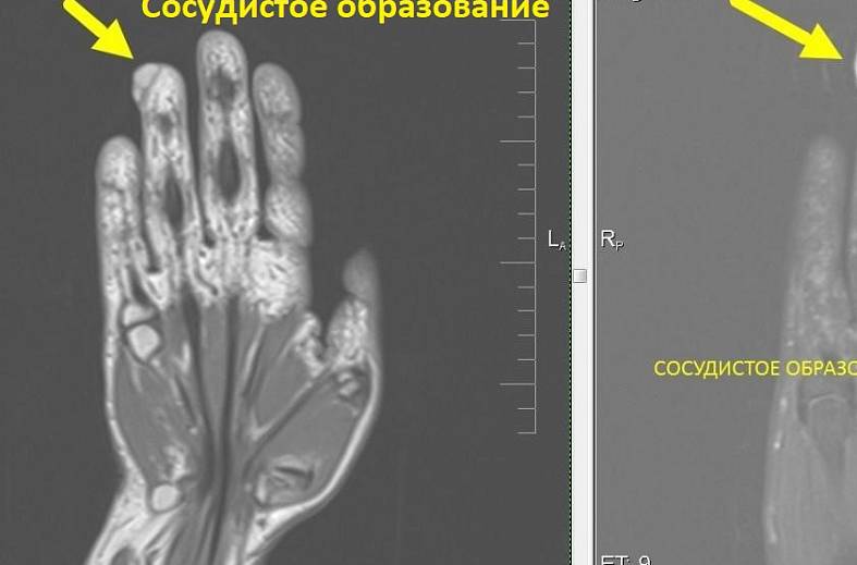 МРТ-исследование кисти