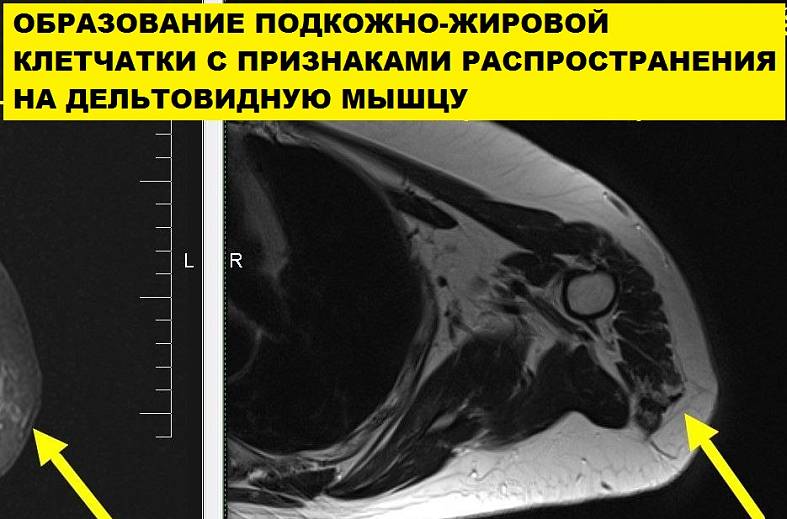 МРТ мягких тканей конечности (одна область)