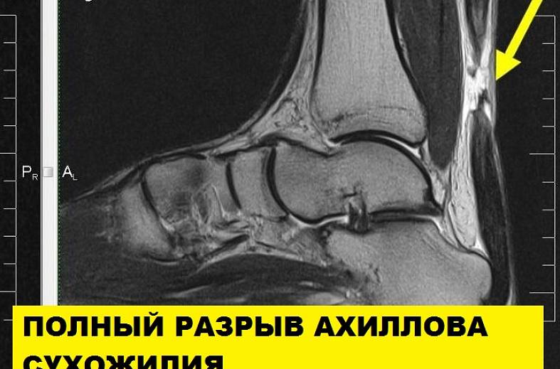 МРТ голеностопного сустава