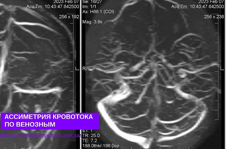 Бесконтрастная МРТ венография головного мозга 