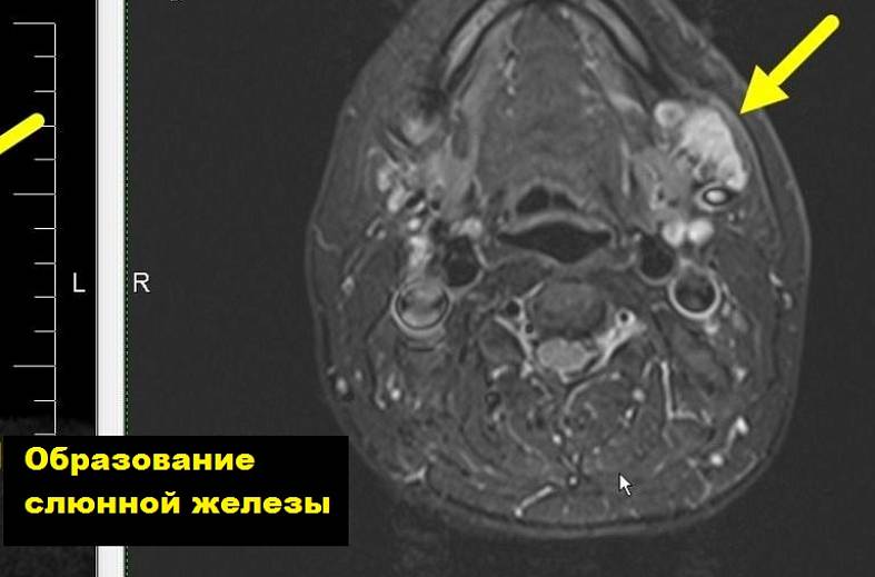 МРТ мягких тканей шеи